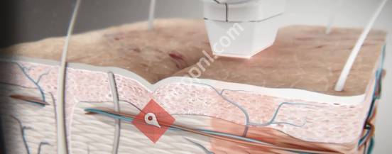Laser & Peelings Bernheze